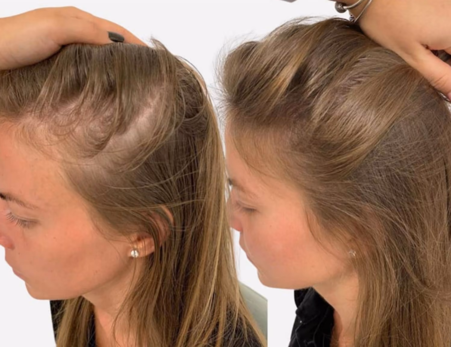 female hair thinning treatment