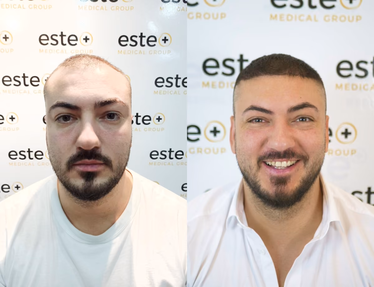 Hair transplant before and after Leeds