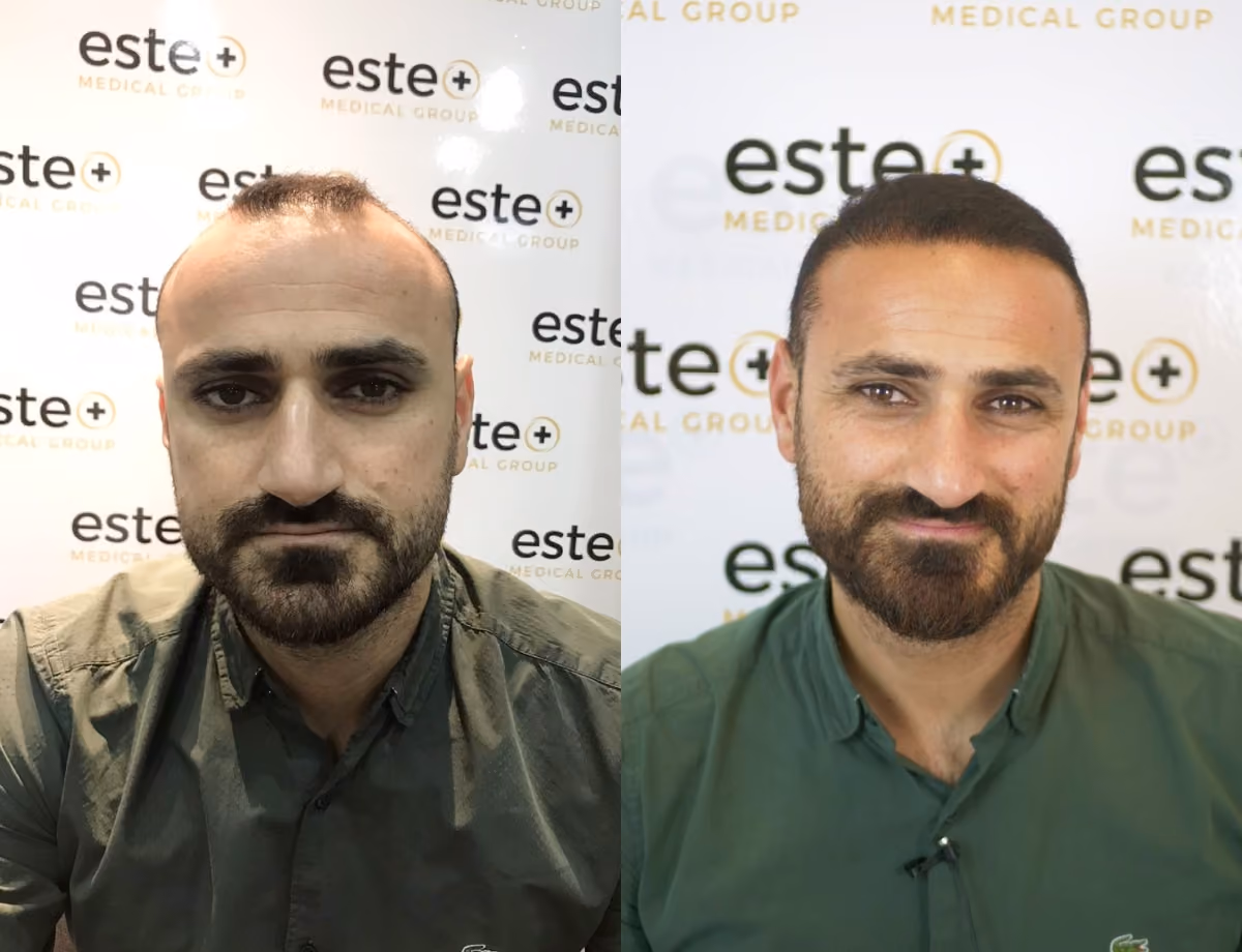 Hair transplant before and after Leeds
