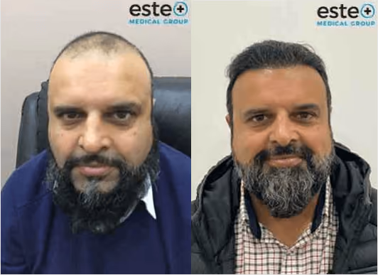 Sakal ekimi Türkiye