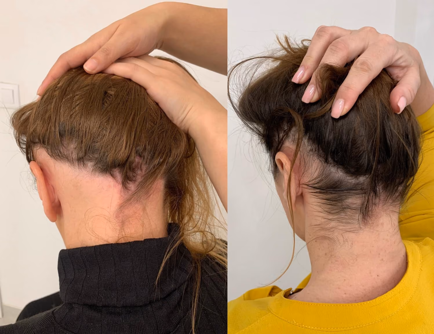 Hair loss for women treatment