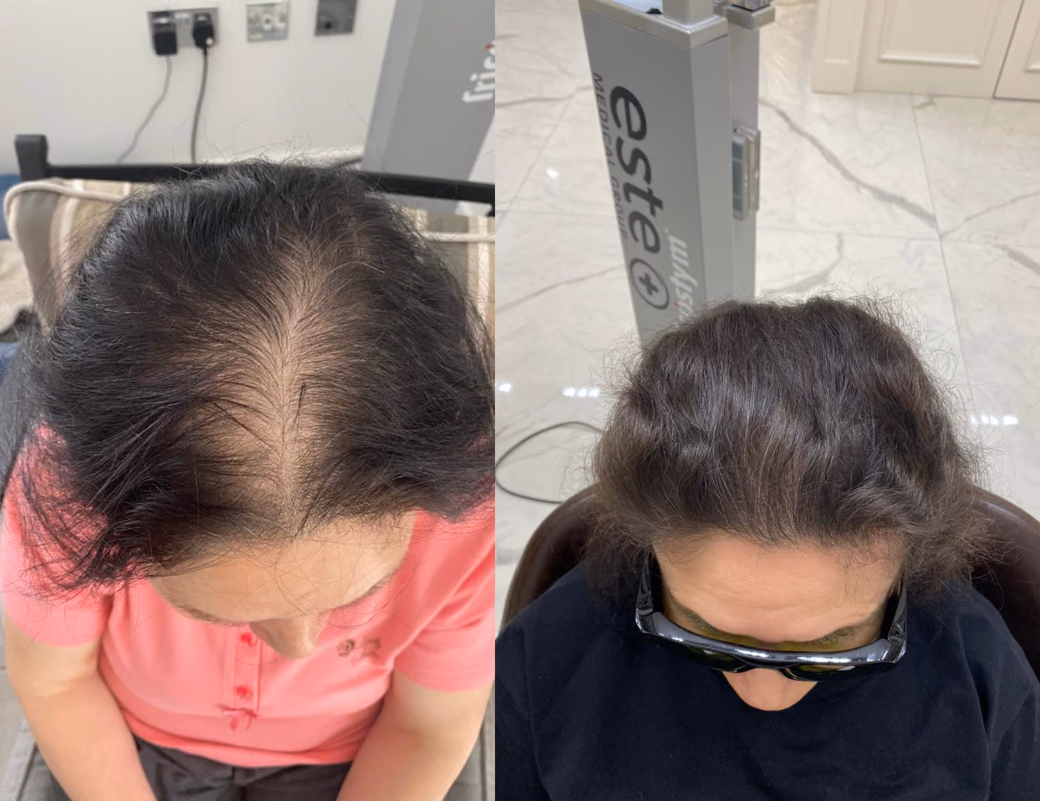 laser hair regrowth for women