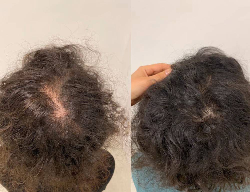 Treatments for female hair loss 