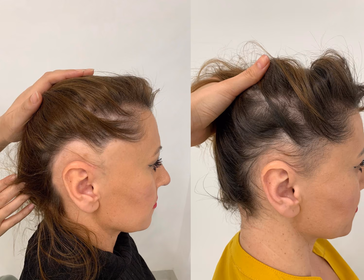 Hair loss for women results