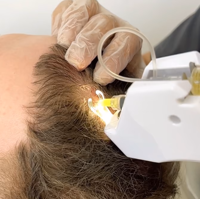 Mesotherapy Hair UK