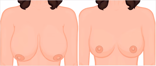 What makes FUE Hair Transplant Procedure the most Successful Technique?