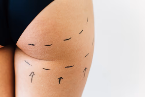 What makes FUE Hair Transplant Procedure the most Successful Technique?