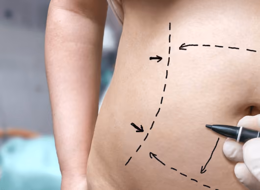 What makes FUE Hair Transplant Procedure the most Successful Technique?