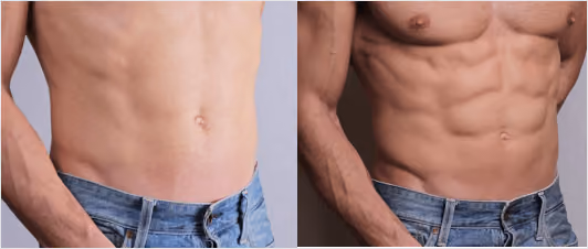 What makes FUE Hair Transplant Procedure the most Successful Technique?