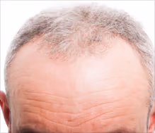 severe hair loss