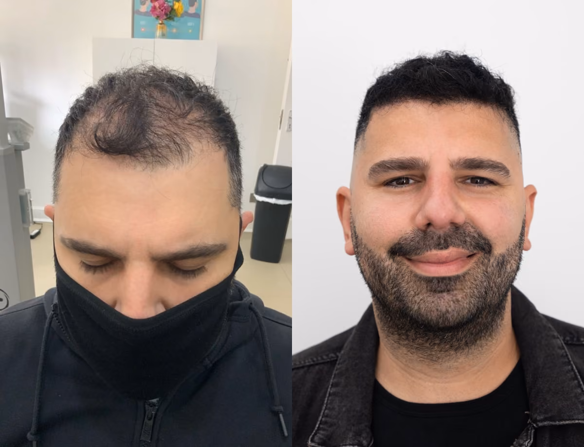 Hair transplant before and after Leeds