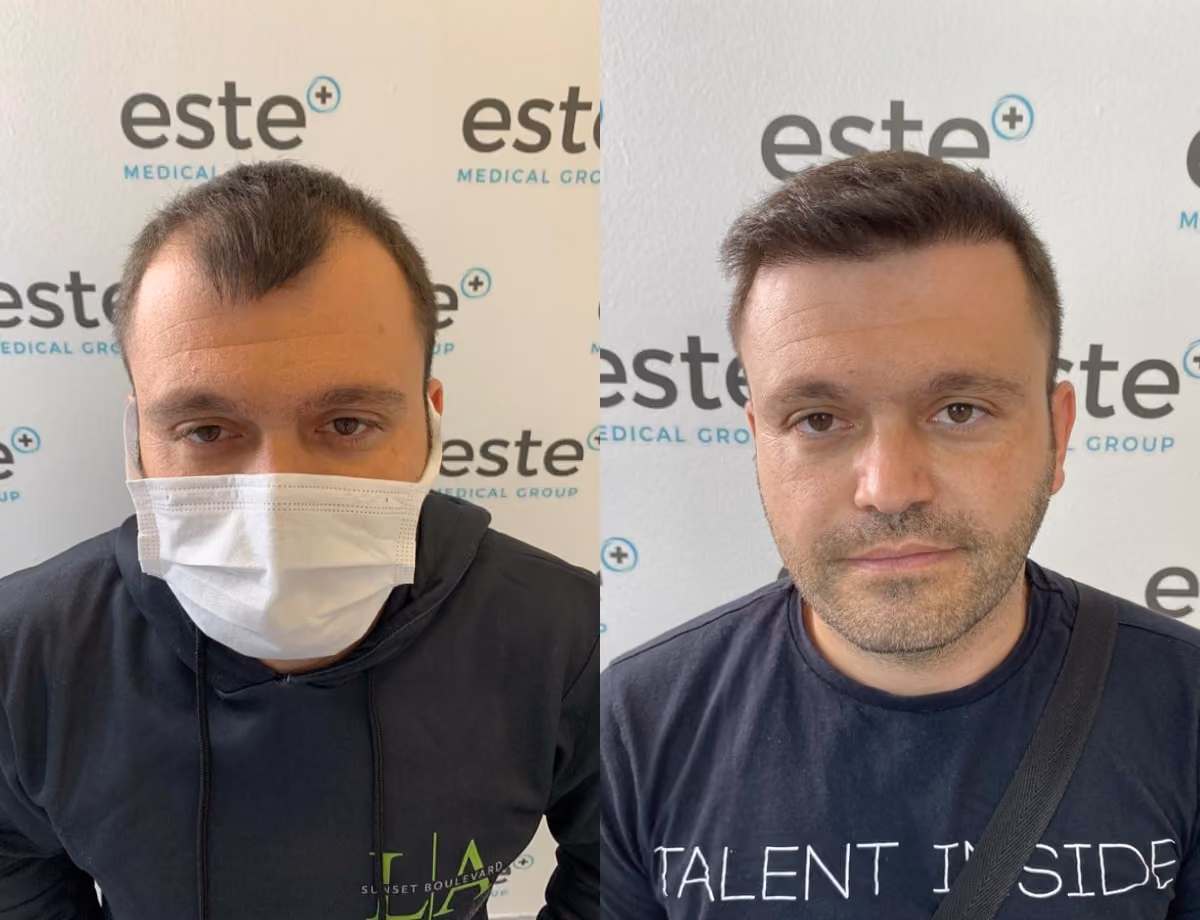 Hair transplant before and after Leeds
