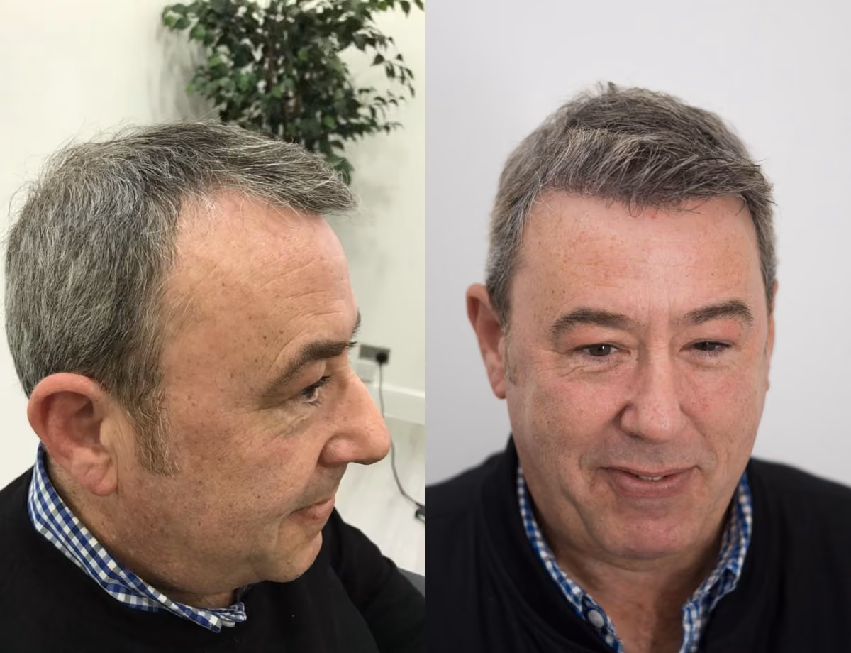 Hair transplant before and after Leeds