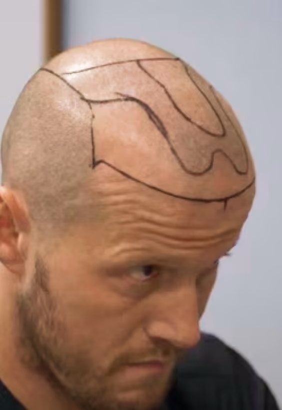 Ian FUE Hair Transplant Story - Este Medical