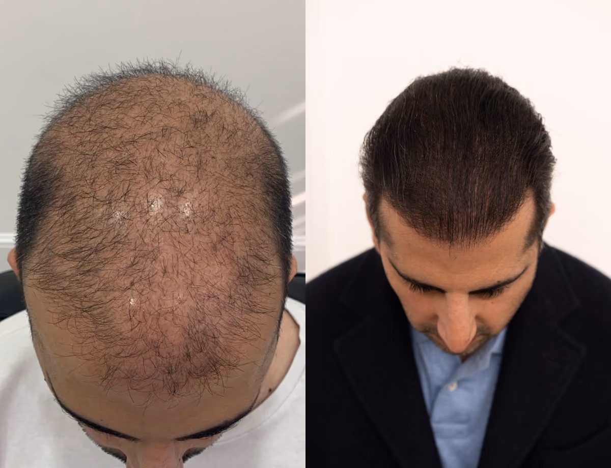 Hair transplant before and after Leeds