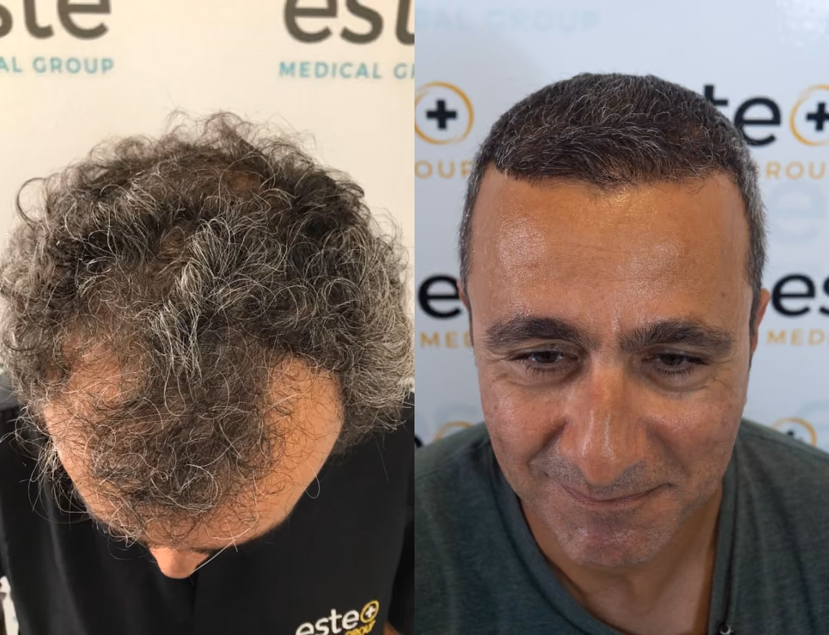 Hair transplant before and after Leeds