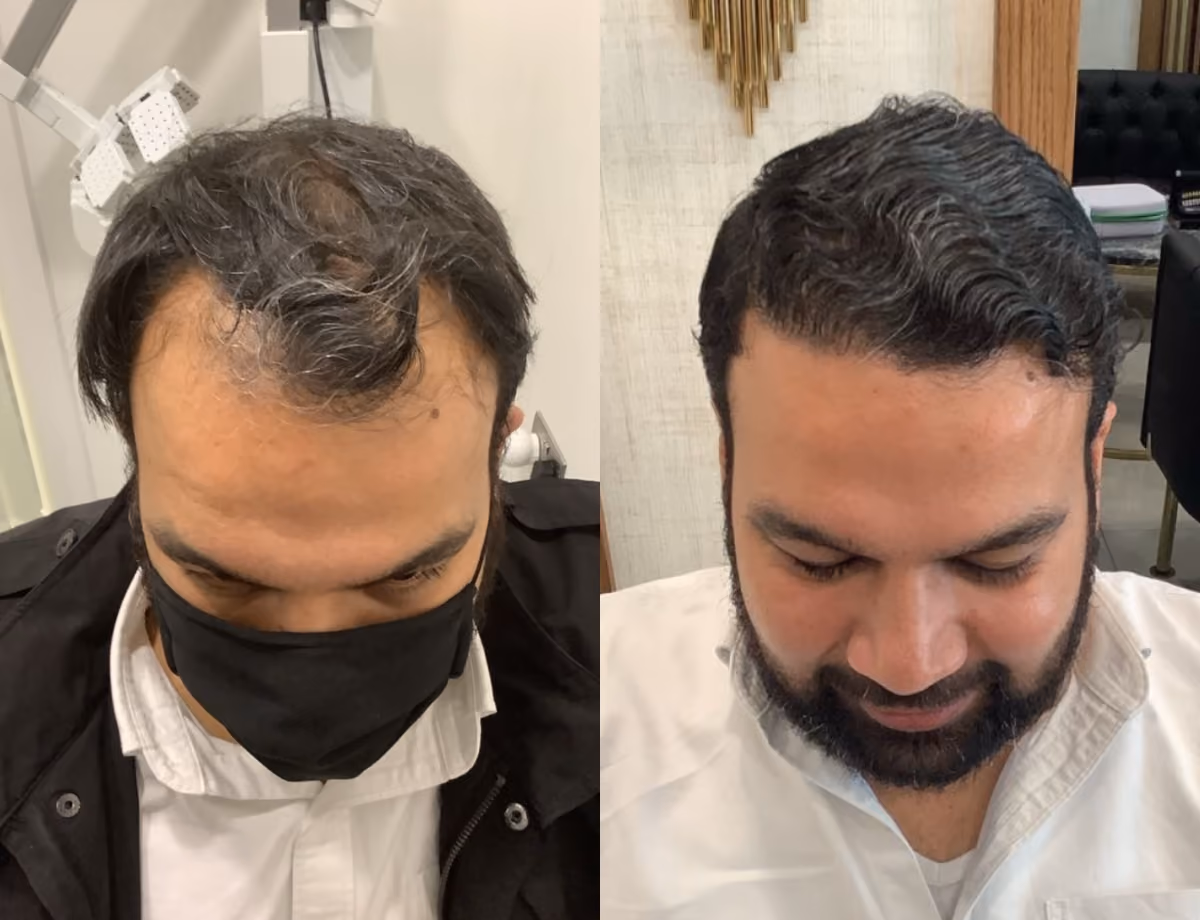 Hair transplant before and after Leeds