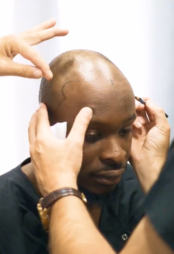 Joshua FUE Hair Transplant Story - Este Medical
