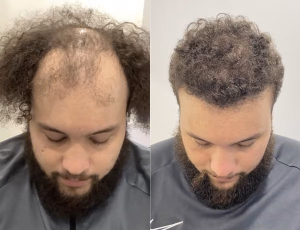 Hair transplant before and after Leeds
