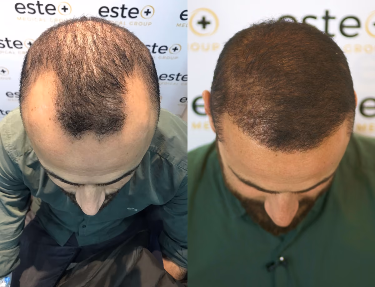 Hair transplant before and after Leeds