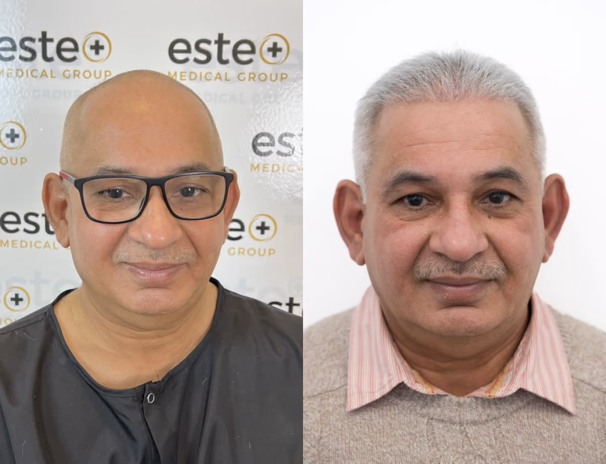 FUE Hair Transplant Results