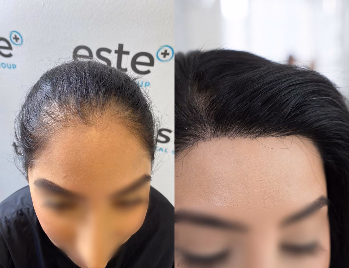 Hair transplant before and after Leeds