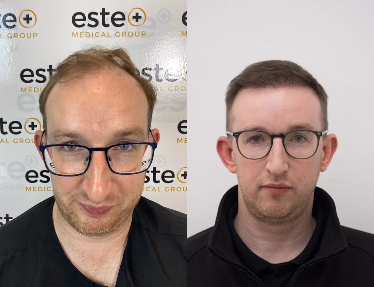 FUE Hair Transplant Results