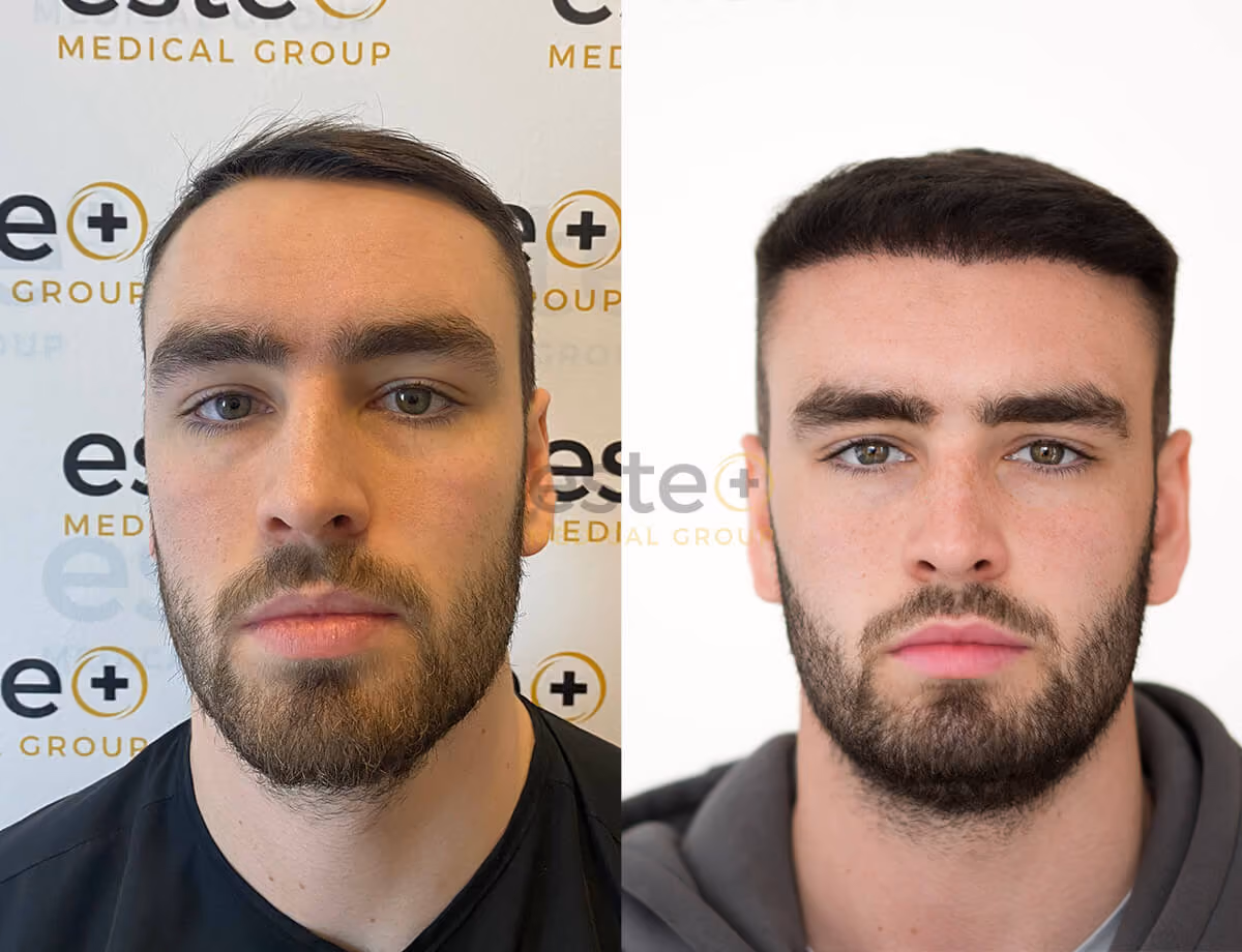 Hair transplant before and after Leeds