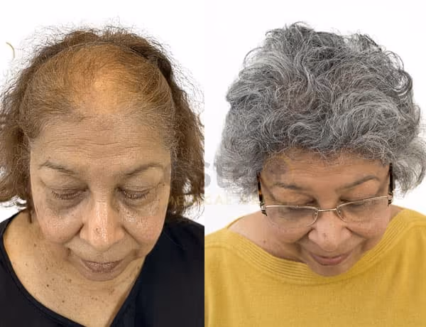 Halima's Hair transplant - Este UK