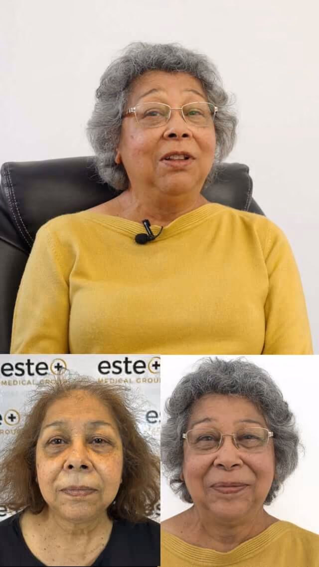 Halima's Hair transplant - Este UK