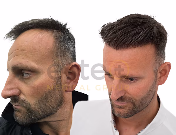 Dazz Hair Transplant before after images - Este