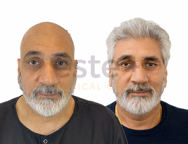 Bobby's Hair Transplant Before After - Este