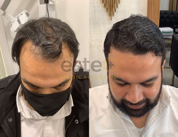 Hair transplant before and after Leeds