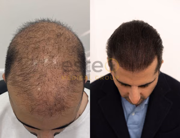 Hair transplant before and after Leeds