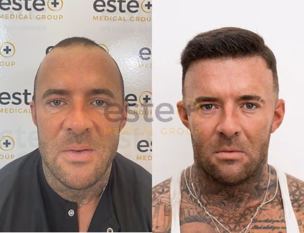 Hair transplant before and after Leeds