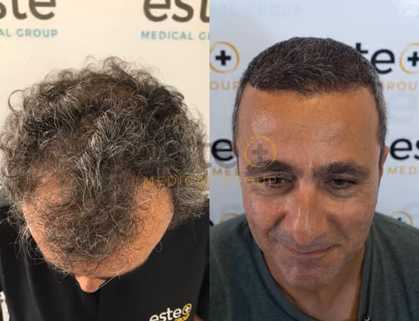 Hair transplant before and after Leeds