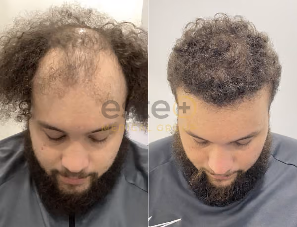 Hair transplant before and after Leeds