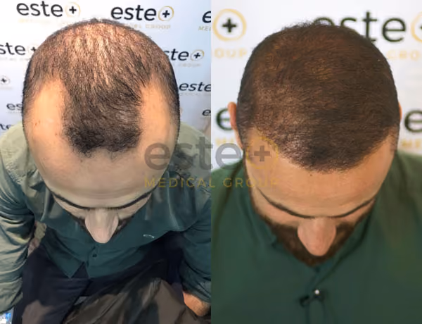 Hair transplant before and after Leeds