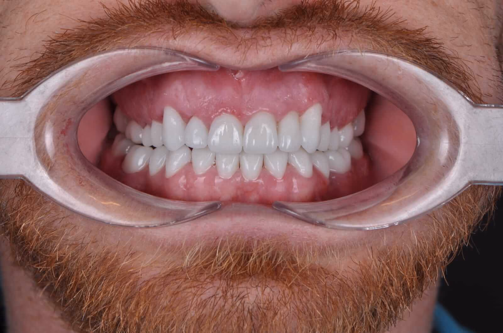 What makes FUE Hair Transplant Procedure the most Successful Technique?