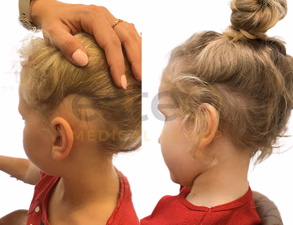 Zofia alopecia before after images - Este