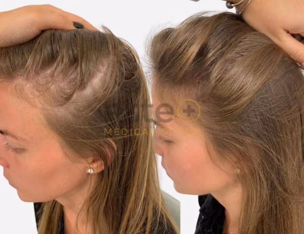 female hair thinning treatment