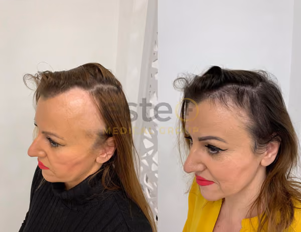 Laser hair regrowth before and after