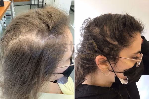 Hair loss for women results