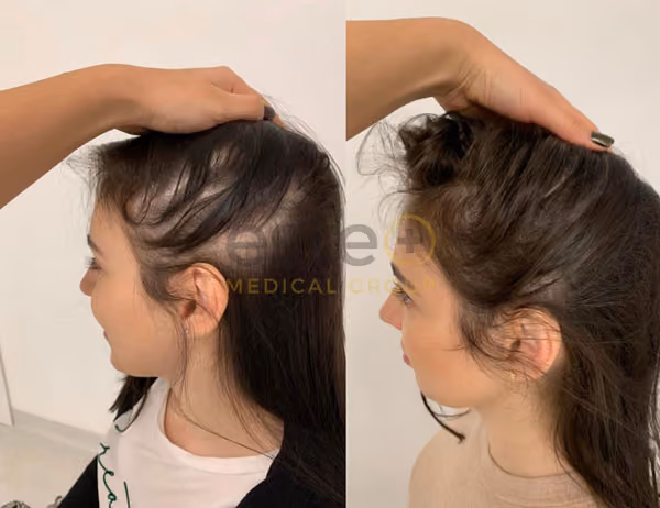 Before and after laser hair regrowth 