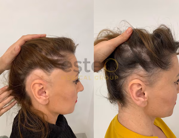 Hair loss for women results