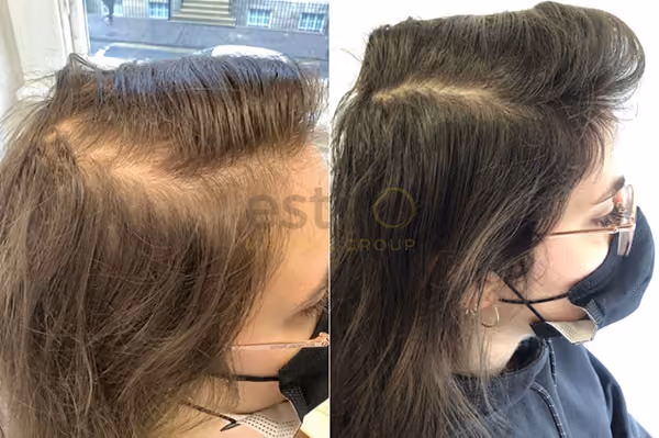 Treatments for female hair loss 