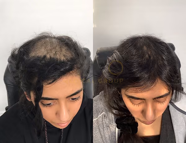 Treatments for female hair loss 