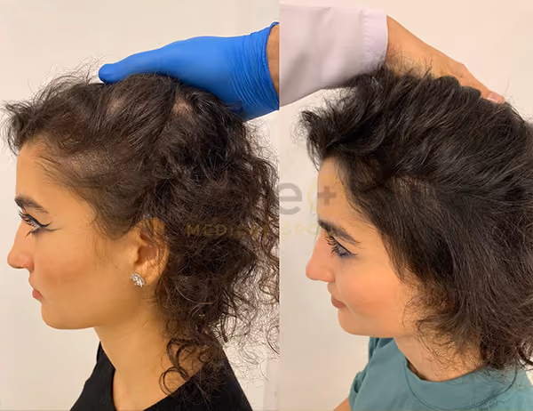 Treatments for female hair loss 
