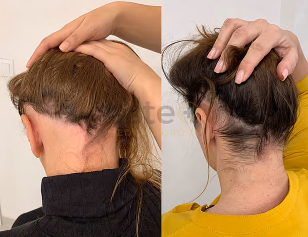 Treatments for female hair loss 