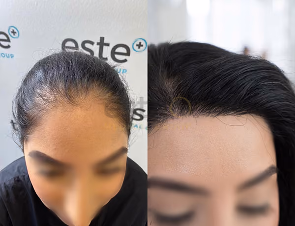 Treatments for female hair loss 
